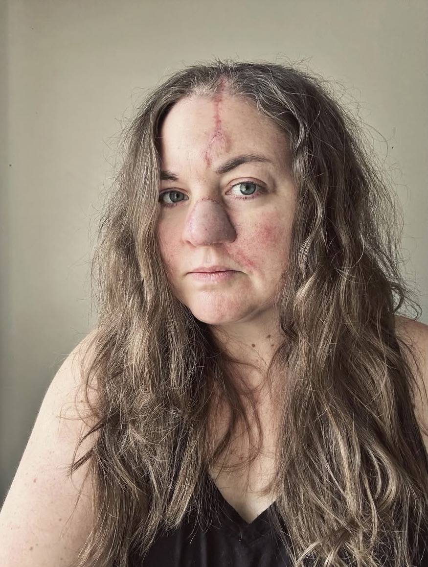 Smiling woman restored after 3D bioprinted nasal reconstruction